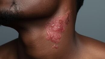 Why Perfume Stings Your Neck: Causes, Sensitivity, and Safe Application Tips